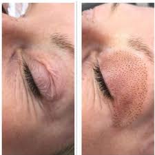 Fibroblast en Párpados