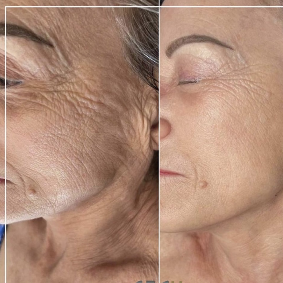 Fibroblast Facial Completo