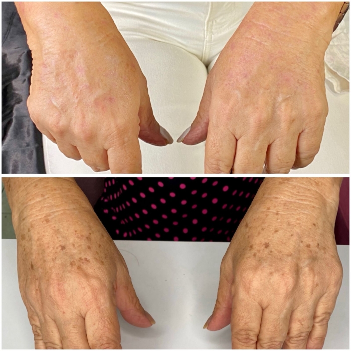 Fibroblast en Manos | Rejuvenecimiento y Retiro de Manchas