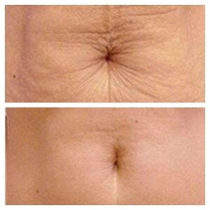 Fibroblast Corporal | Zona Específica